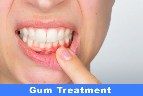 Gum Surgery